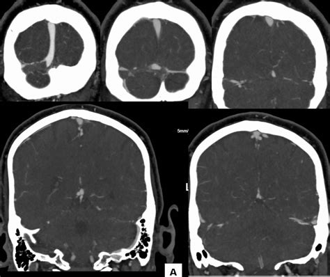 Dural Sinus Thrombosis