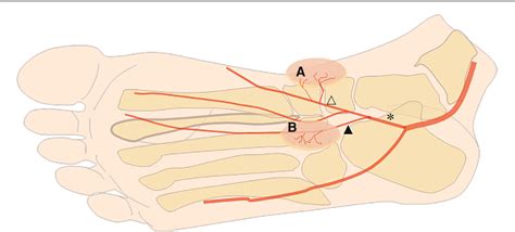 Figure 1 From Medial Plantar Artery Perforator Mpap Flap Is An Ideal