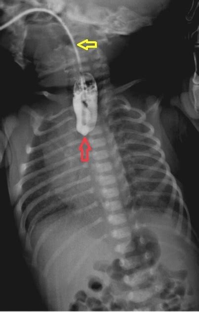 Esophageal Atresia X Ray