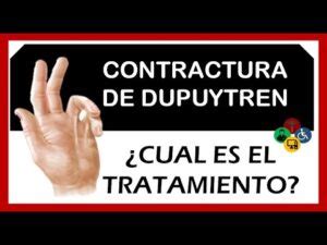 Todo Sobre La Contractura De Dupuytren Y Su Tratamiento Cl Nica