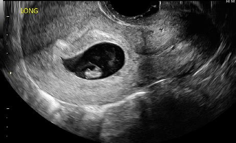 Ultrasound in the First Trimester (All Topics) and Components of Fetal ...