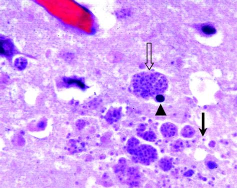 Toxoplasmosis Brain Pathology