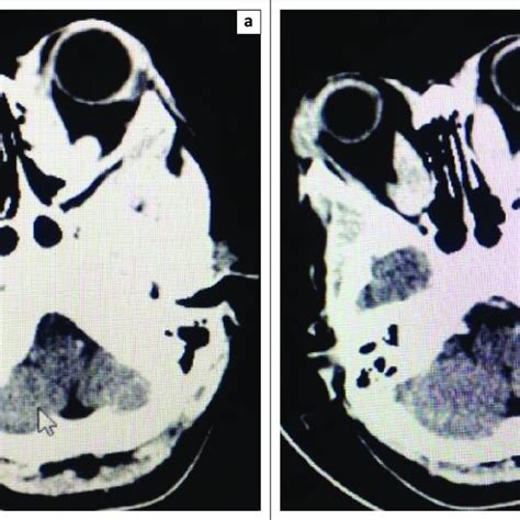 (PDF) Jod-Basedow phenomenon: Reactivation of thyroid eye disease after contrast computed tomography