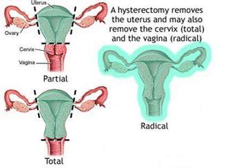 Laparoscopic Hysterectomy – Indications, Procedure, Recovery, Cost