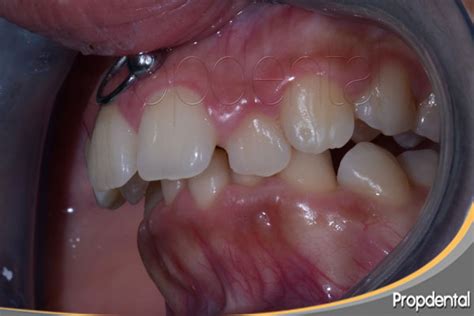 Sobremordida Tratamiento De La Sobremordida Con Ortodoncia