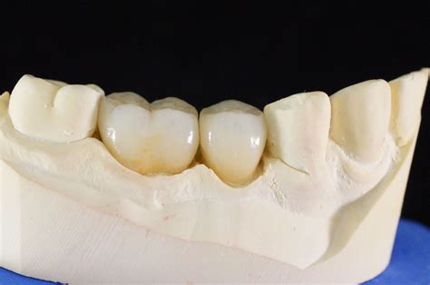 Ips E Max Porcelain Crowns Olivadds Porcelain Crowns Dental