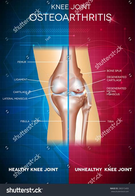 Osteoarthritis And Healthy Knee Joint Healthy Part Of The Joint On A