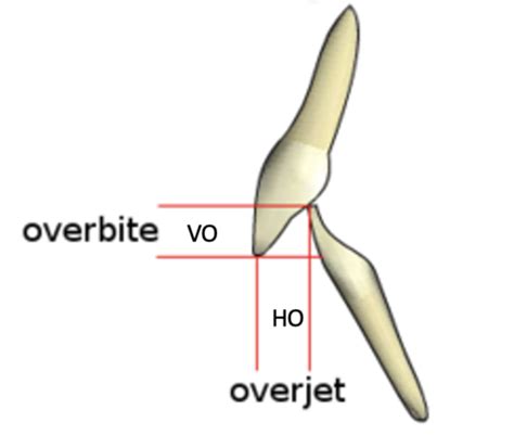 Static Occlusion Flashcards Quizlet