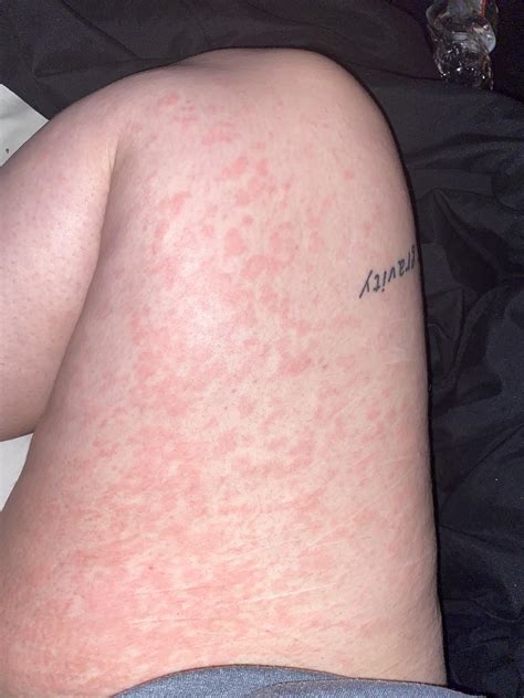 Rash On Inner Thigh What Does This Look Like R Medical Advice