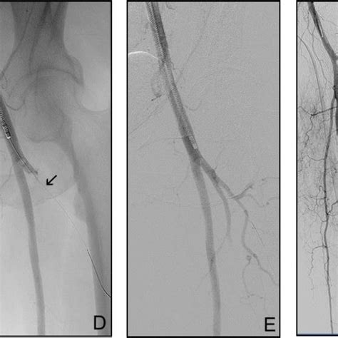 81 Year Old Woman Ali Iib Iii A Aortic Bifurcation Saddle Embolism