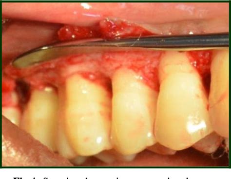 Figure From Open Flap Debridement Using Microsurgical Loupes And