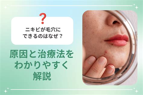 ニキビが毛穴にできるのはなぜ？原因と治療法をわかりやすく解説 梅田すずらんクリニックブログ