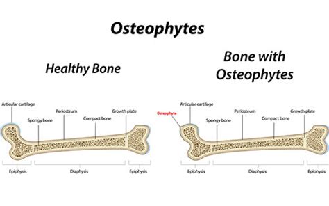 Osteophytes, or bone growths – causes, symptoms, treatment – Healthy ...