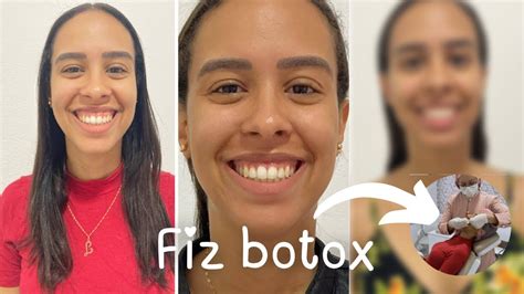 Fiz Botox Para Corrigir O Sorriso Gengival Youtube