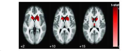 Statistical Parametric Map Overlaid On An MRI Template Neurological