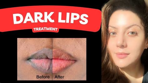 Lip Pigmentation Treatment I Dark Lips To Pink Lips Treatment I