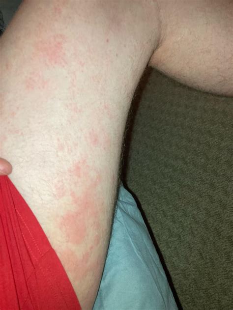 Rash On Inside Of Thighs R Dermatologyquestions