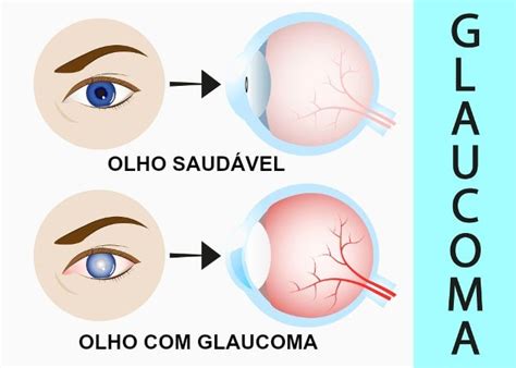 Tratamento De Glaucoma Rj Causas Prevenção E Tratamento Dr