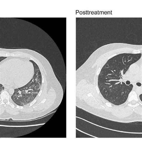 Chest Computed Tomography Scans Without Contrast For Patient 1 At