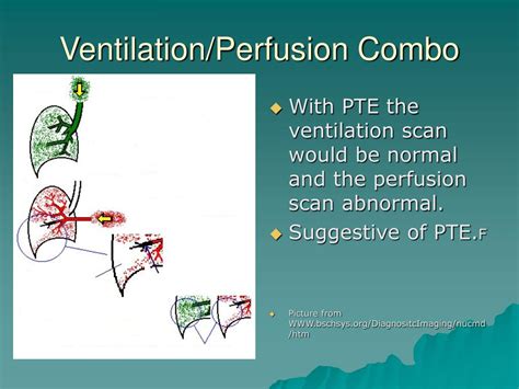 Ppt Pulmonary Thromboembolism Powerpoint Presentation Free Download