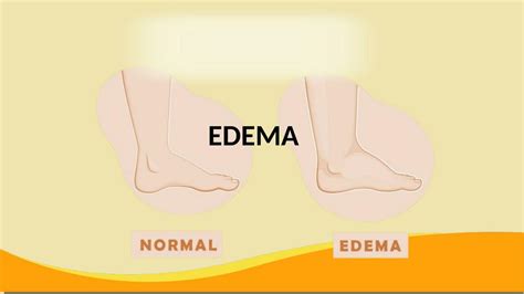 Semiolog A Del Edema Sanchez Jose Udocz