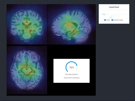 Explainable Deep Learning Models For Dementia Identification Via