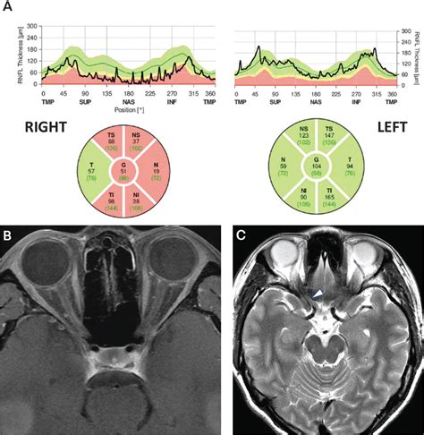 Optic Neuritis Pmc