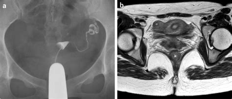 Diagnosis Of Unicornuate Uterus With A Non Communicating Rudimentary