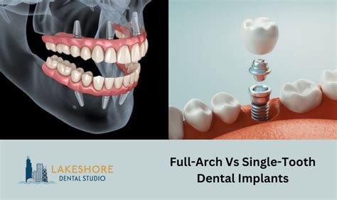 Full-Arch vs. Single-Tooth Implants: Which Is Right for You?