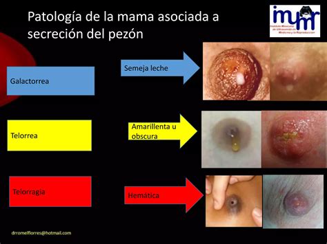 Lesiones Benignas Y Malignas De La Mama Por Ultrasonido Dr Romel