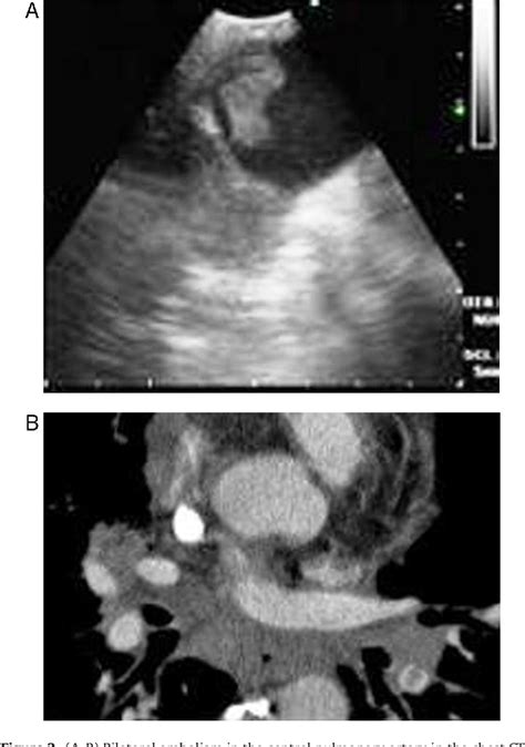 Figure 1 From Diagnostic Imaging Of Pulmonary Embolism Using