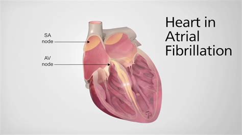 Atrial Fibrillation Youtube