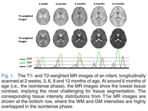 Measuring Brain Growth And Maturation Over The First Year Of Life A