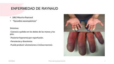 Enfermedad De Raynaud Ariagna García Udocz