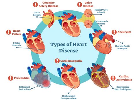 Cardiovascular Disease Types Signs Prevention And Causes