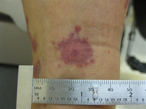 Identifying 21 Common Red Spots on Skin - Universal Dermatology