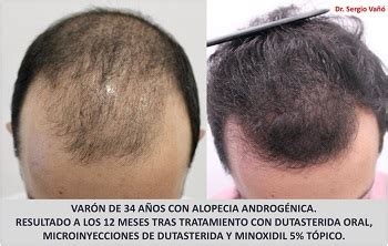 Fotos de antes y después de dutasterida y minoxidil