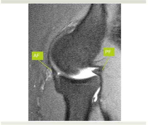 Figure From Elbow Synovial Fold Syndrome Semantic Scholar