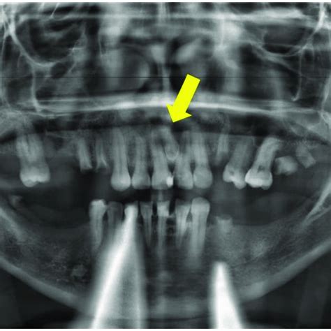 Periapical X-ray showing supernumerary tooth located between tooth 1.1 ...