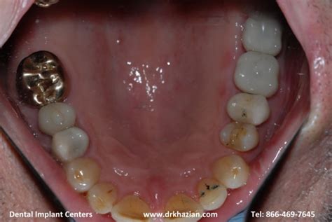 Molar Implant Teeth | San Diego Dental Implant Centers