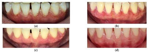 Dentistry Journal Free Full Text Evaluation Of Carbon Dioxide Laserassisted Treatment For