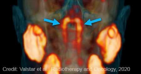 New Salivary Glands Discovered. Previously unnoticed salivary glands ...