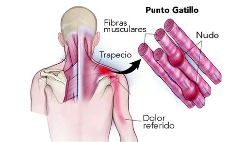 Mapa De Los Puntos Gatillo Qu Son Y C Mo Tratarlos Jl Fisios