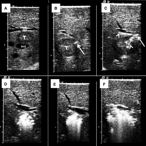 Optimal Cytoreduction After Combined Resection And Radiofrequency