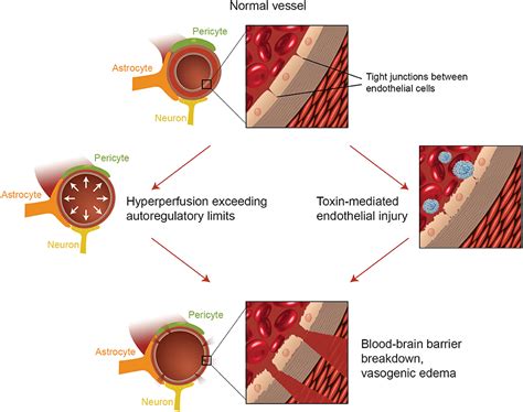Frontiers | Posterior Reversible Encephalopathy Syndrome (PRES ...
