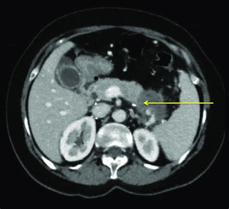 An Enhanced CT Scan Cross Sectional View Shows Pancreatic Tail