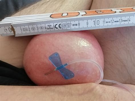 Saline Infusion In Scrotum First Try 1 Liter 25 Pics Xhamster