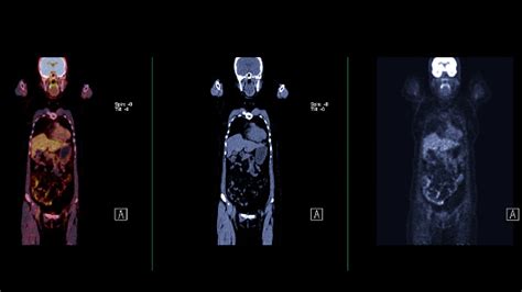 A Petct Scan Image Is A Diagnostic Visualization Combining Positron