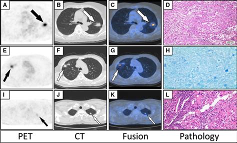 Ad Axial Pet Ct Fused Pet Ct And Pathology Images Of A