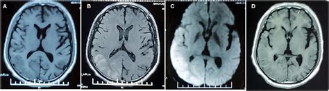 Frontiers Prolonged Hemiplegic Migraine Led To Persistent